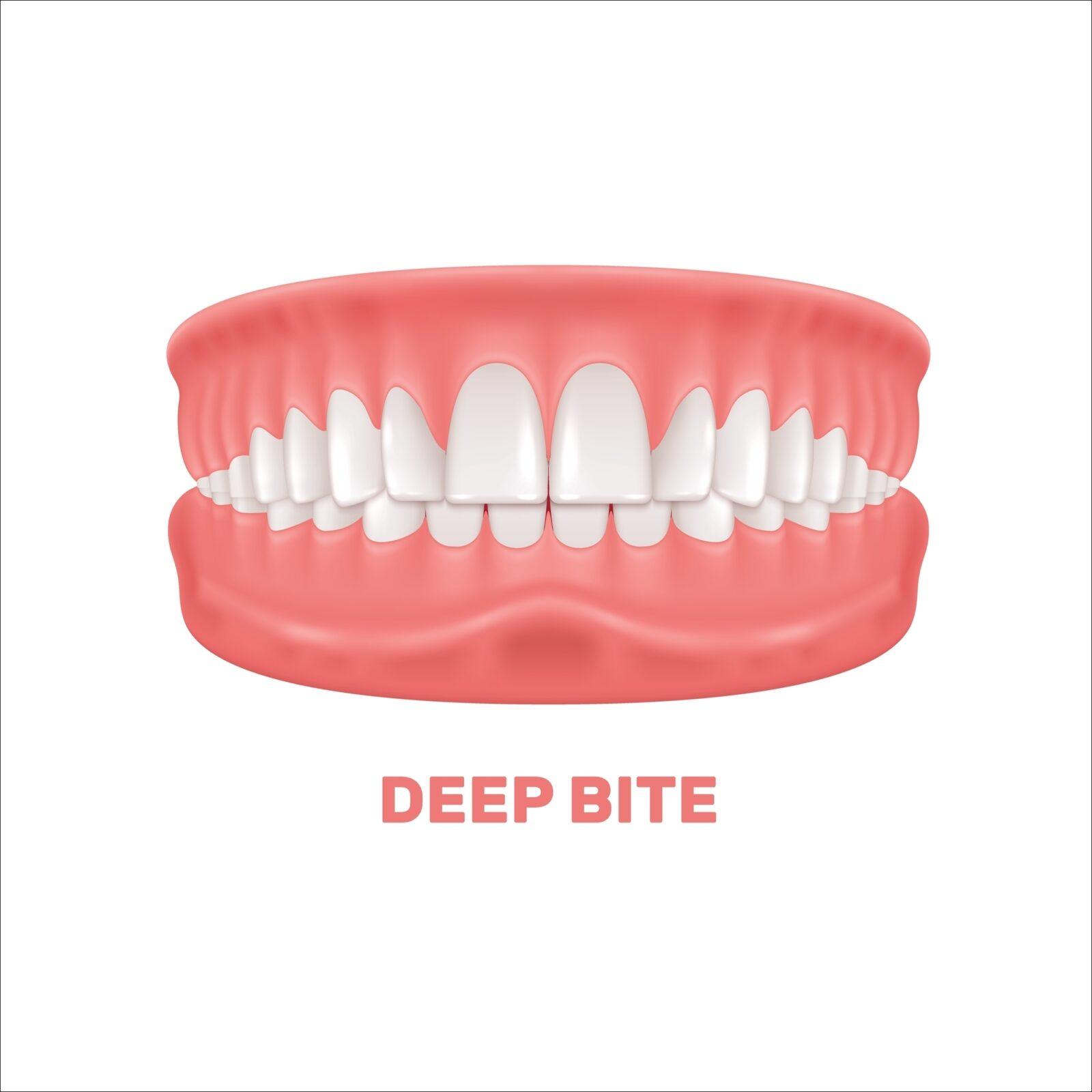 deep bite illustration